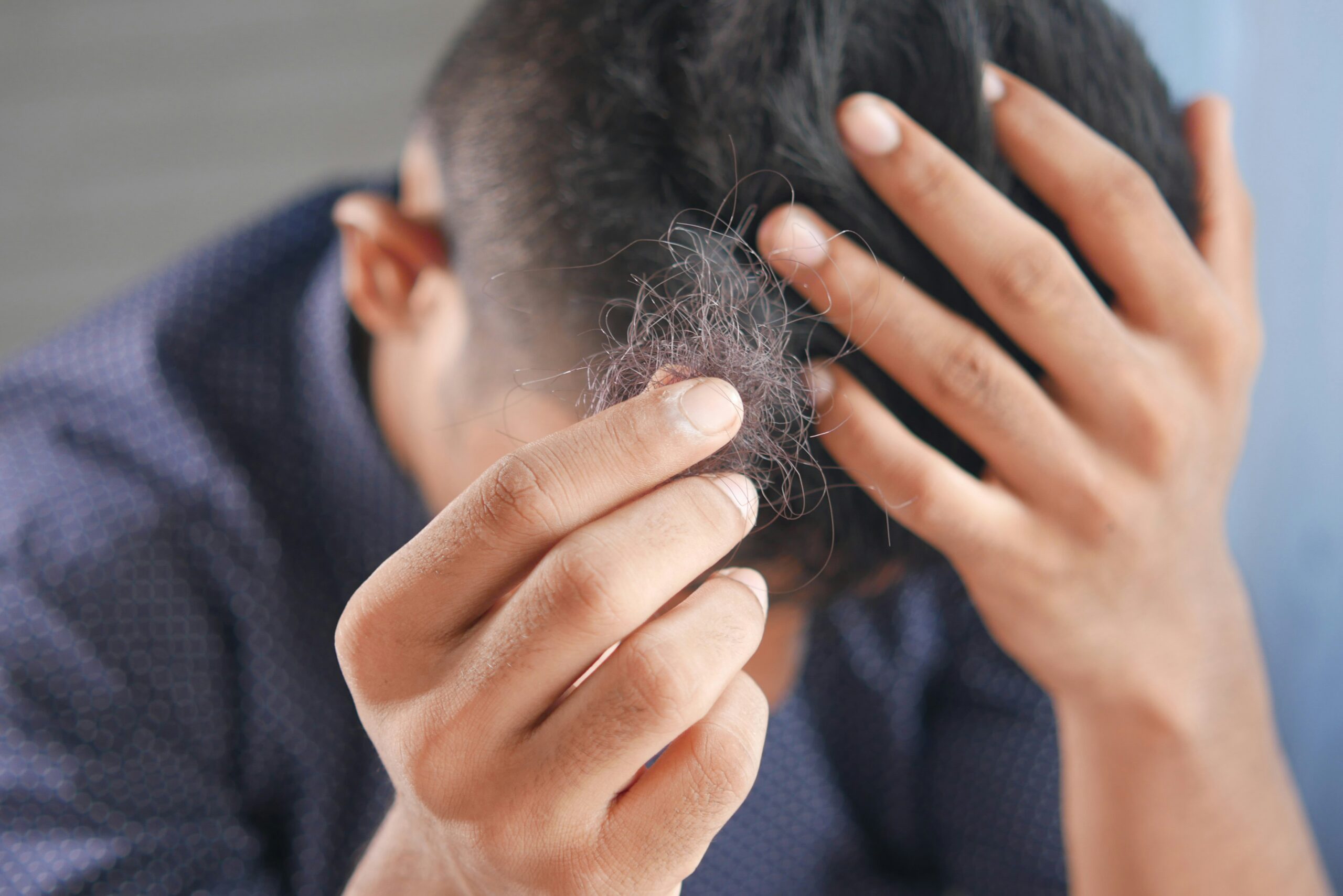 Hair Loss Treatment: The Benefits, Risks, and Side Effects of Finasteride and Minoxidil